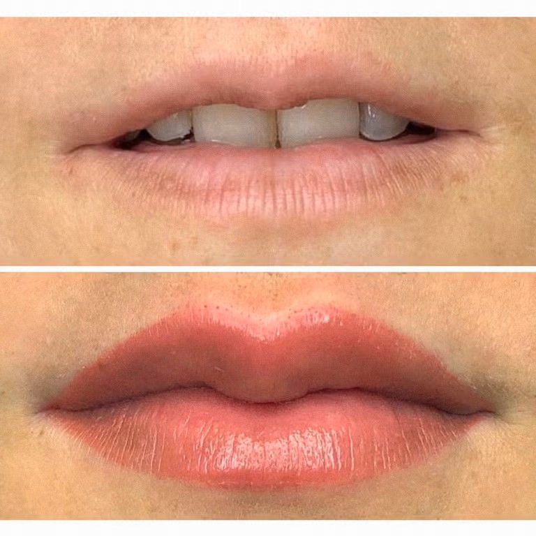Antes y después de micropigmentación de labios
