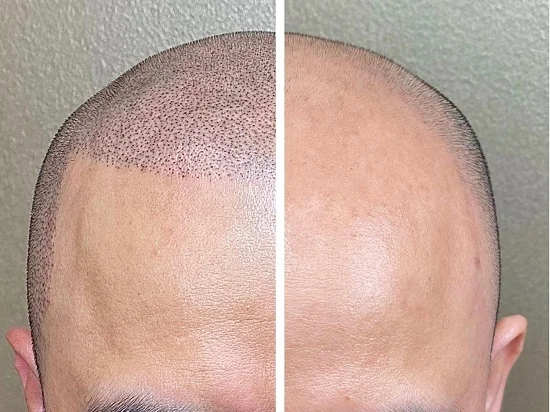Micropigmentación capilar, efecto cabello rapado